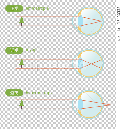 Illustration set of normal eye, myopic eye, and hyperopic eye 124303324