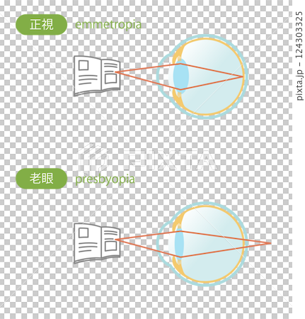 Illustration set of normal and presbyopic eyes Illustration set of normal and presbyopic eyes 124303325