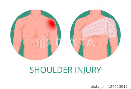 Shoulder injury medical treatment. Human body part first aid infographic, injured shoulder torso part first aid methods flat vector illustration. Cartoon medical bandaging Shoulder injury medical treatment. Human body part first aid infographic, injured shoulder torso part first aid methods flat vector illustration. Cartoon medical bandaging 124313611