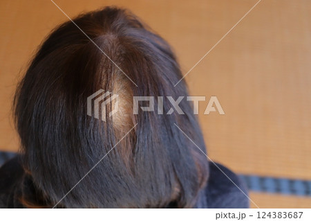 部分ばげの薄毛治療 部分ばげの薄毛治療 124383687