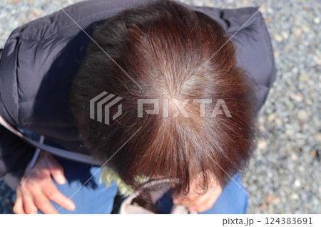薄毛治療の女性 124383691