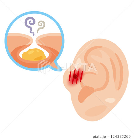 炎症が起きた耳瘻孔のイラスト 124385269