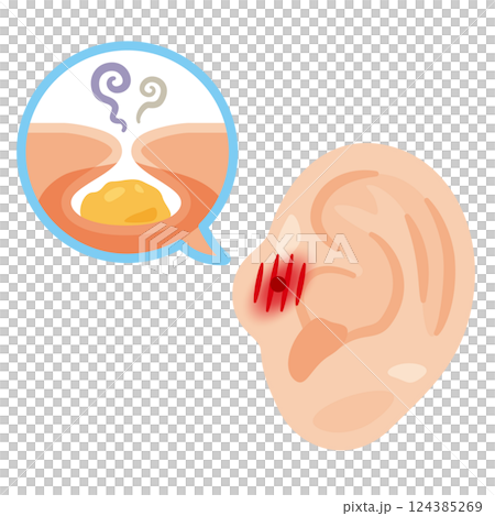 炎症が起きた耳瘻孔のイラスト 124385269