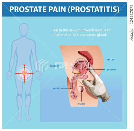 Understanding Prostate Pain and Inflammation 124387072