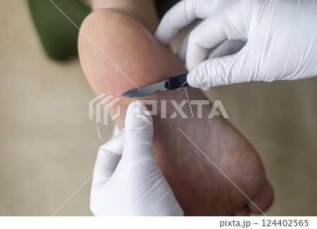 Medical procedure of scraping the skin of the foot for laboratory analysis and diagnosis of fungal infections. A doctor in sterile gloves takes a tissue sample using a scalpel and a slide 124402565