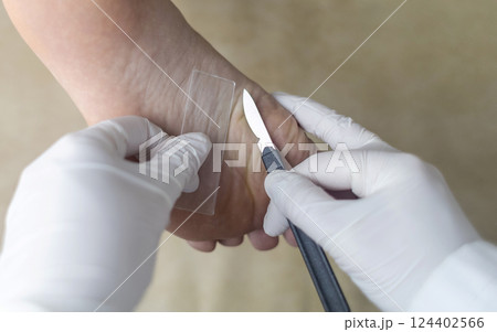 Medical procedure of scraping the skin of the foot for laboratory analysis and diagnosis of fungal infections. A doctor in sterile gloves takes a tissue sample using a scalpel and a slide Medical procedure of scraping the skin of the foot for laboratory analysis and diagnosis of fungal infections. A doctor in sterile gloves takes a tissue sample using a scalpel and a slide 124402566