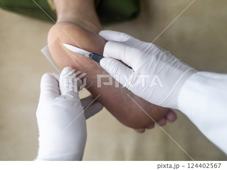 Medical procedure of scraping the skin of the foot for laboratory analysis and diagnosis of fungal infections. A doctor in sterile gloves takes a tissue sample using a scalpel and a slide Medical procedure of scraping the skin of the foot for laboratory analysis and diagnosis of fungal infections. A doctor in sterile gloves takes a tissue sample using a scalpel and a slide 124402567