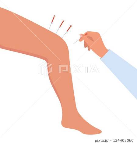 Acupuncture Therapy in Spa Salon. Hand Injects Needles in human leg. Chinese needle alternative medicine and treatment. Vector Illustration. Acupuncture Therapy in Spa Salon. Hand Injects Needles in human leg. Chinese needle alternative medicine and treatment. Vector Illustration. 124405060
