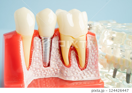 Dental implant, artificial tooth roots into jaw, root canal of dental treatment, gum disease, teeth model for dentist studying about dentistry. Dental implant, artificial tooth roots into jaw, root canal of dental treatment, gum disease, teeth model for dentist studying about dentistry. 124426447