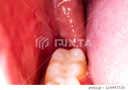 recess after complex impacted wisdom tooth extraction, traumatic healing. Dry socket, alveolitis, macro. Copy space for text recess after complex impacted wisdom tooth extraction, traumatic healing. Dry socket, alveolitis, macro. Copy space for text 124447720