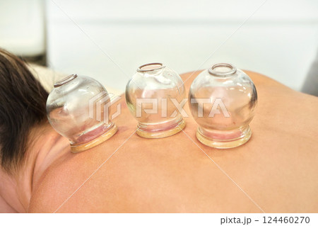 Glass cups sucked on back of young woman - closeup detail of cupping therapy, alternative medicine form 124460270