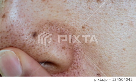 日本人男性の鼻の黒ずみ 124504043