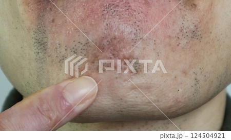脱毛で薄くなった髭を指差す男性 脱毛で薄くなった髭を指差す男性 124504921