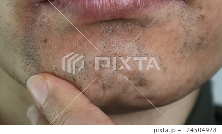 脱毛で薄くなった髭を触る日本人男性 124504928