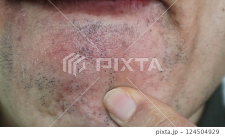 脱毛で薄くなった髭を指差す日本人男性 124504929