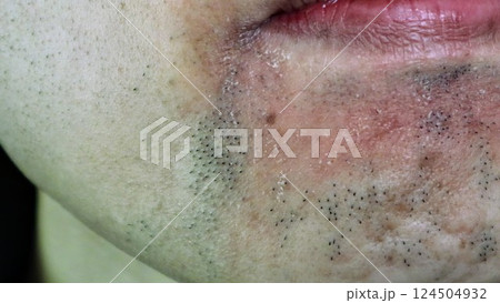 脱毛で髭の量が減った日本人男性 124504932