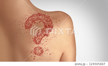 Measles Information 124505887