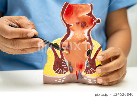 Asian doctor with rectum and hemorrhoid human anatomy model at hospital, inflamed vascular structure. Asian doctor with rectum and hemorrhoid human anatomy model at hospital, inflamed vascular structure. 124526840