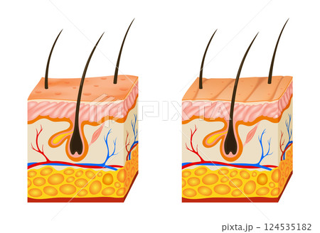 Oily and dry skin anatomy. Human body skin vector illustration with parts vein artery hair sweat gland epidermis dermis and hypodermis. Human Cross-section of the skin layers structure 124535182