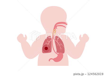 Aspiration pneumonia poster 124562819