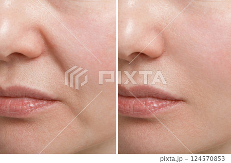 Female nasolabial fold before and after wrinkle smoothing procedures. Correction of the chin and neck shape. 124570853