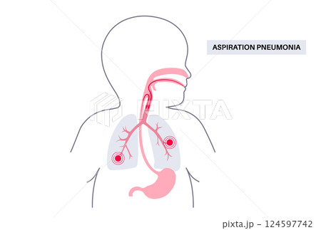 Aspiration pneumonia poster Aspiration pneumonia poster 124597742