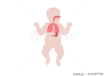 Aspiration pneumonia poster Aspiration pneumonia poster 124597744