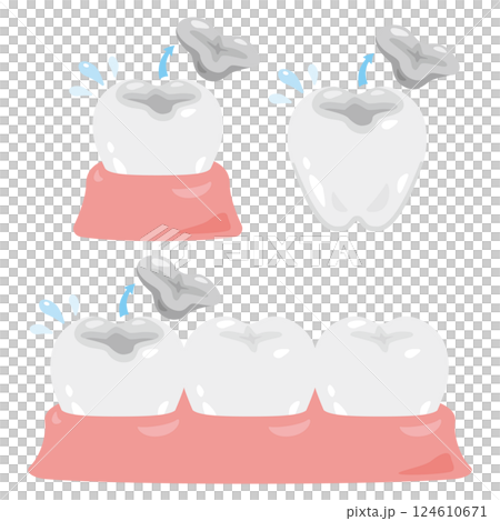 插圖組帶有可拆卸填充物的牙齒 插圖組帶有可拆卸填充物的牙齒 124610671