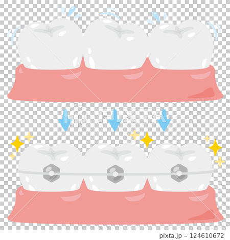Illustration set of misaligned teeth and corrected teeth Illustration set of misaligned teeth and corrected teeth 124610672