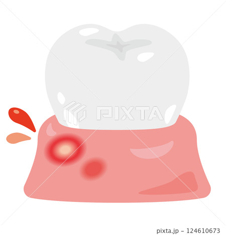 口内炎ができた歯茎のイラスト 124610673