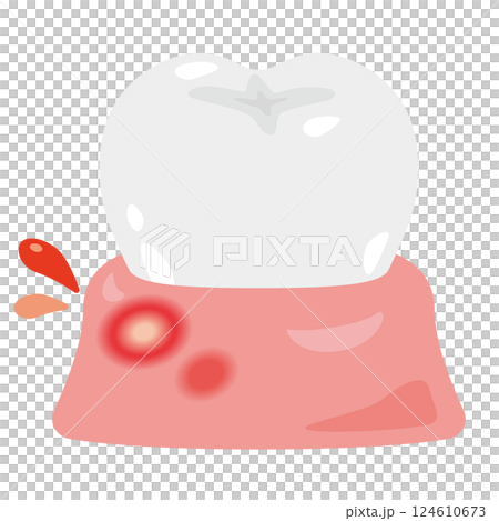 患有口腔炎的牙齦圖示 患有口腔炎的牙齦圖示 124610673