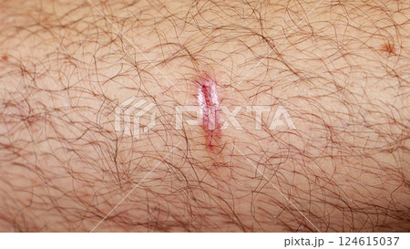Close-up of a small scar on caucasian skin surrounded by hair and red marks, showing healing 124615037
