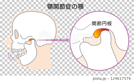 顳顎關節障礙的顎骨圖示 124617579