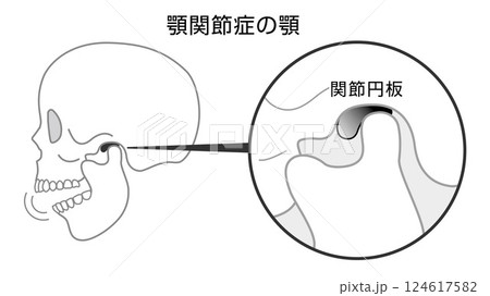 顎関節症の顎の説明イラスト　モノトーン 124617582