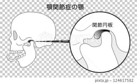 顎関節症の顎の説明イラスト　モノトーン 124617582