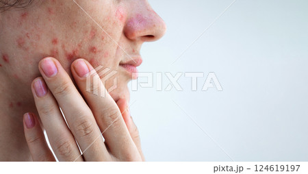 female face with acne and pimples on problem skin closeup on isolated white background female face with acne and pimples on problem skin closeup on isolated white background 124619197