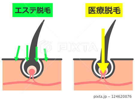 エステや医療で毛根から脱毛をして綺麗な肌になる断面図 124620876