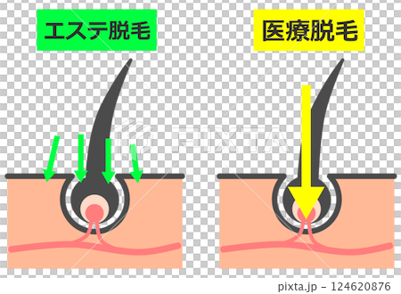 エステや医療で毛根から脱毛をして綺麗な肌になる断面図 124620876