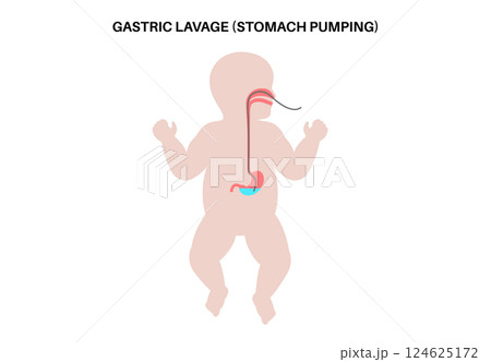 Stomach wash gastric lavage Stomach wash gastric lavage 124625172