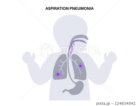 Aspiration pneumonia poster 124634842