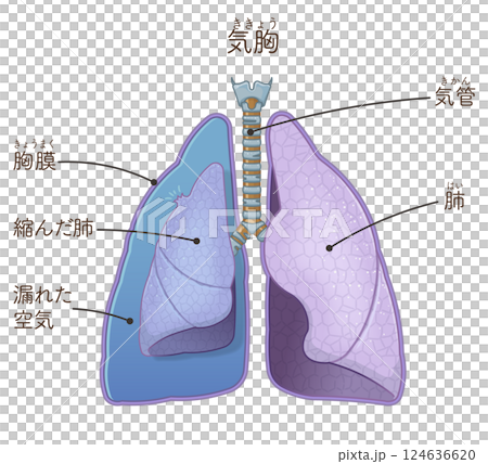Illustration of lungs, trachea and pneumothorax 124636620