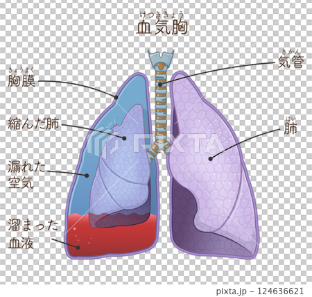 Illustration of lungs, trachea and hemopneumothorax 124636621