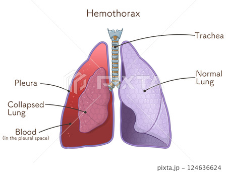 lungs,windpipe,pneumothorax,illustration 124636624