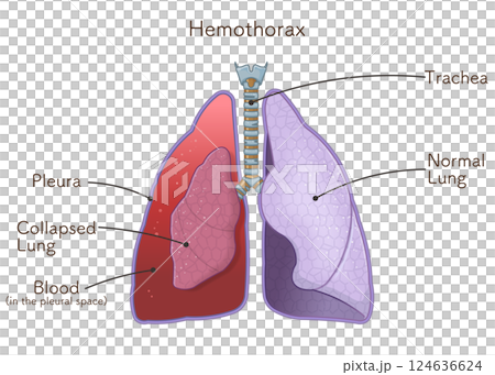 lungs,windpipe,pneumothorax,illustration 124636624