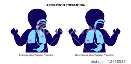 Aspiration pneumonia poster 124665854