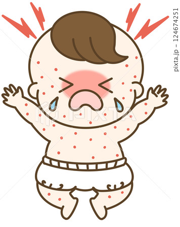 湿疹が出て大泣きしているオムツの男の子の赤ちゃんのゆるかわイラスト 124674251