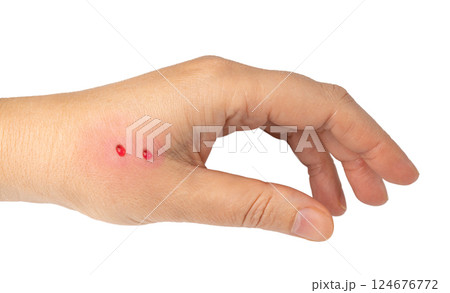 Snake bite on skin, snakebite or cat bite marks close up. Two small fresh blood drops on hand 124676772