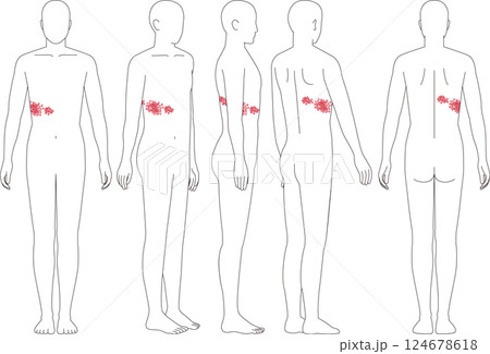 帯状疱疹の症状。正面から側面背面の人間のイラスト 124678618