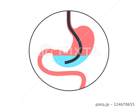 Stomach wash gastric lavage Stomach wash gastric lavage 124678655