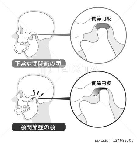顎関節症の症状と説明のイラスト　モノトーン 124688309